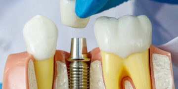 Implante dentário mal executado resulta em condenação de clínica em Natal